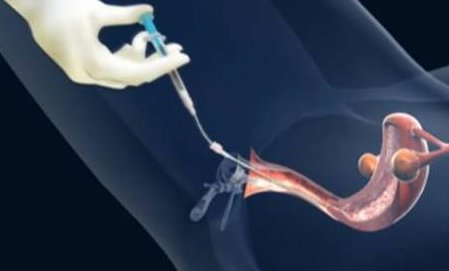 染色体易位在青岛市市立医院（东院区）可以做三代试管吗？染色体平衡易位还能生健康的宝宝吗？